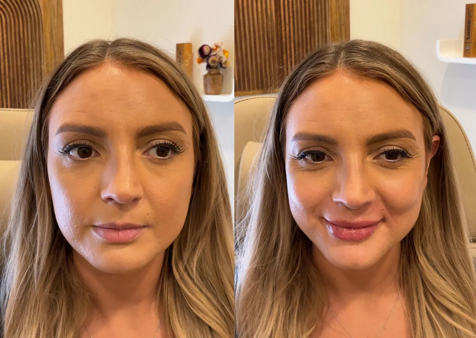 Lip Filler - Before & After